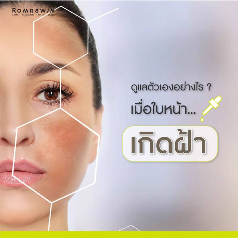 วิธีป้องกันฝ้าตรงโหนกแก้ม