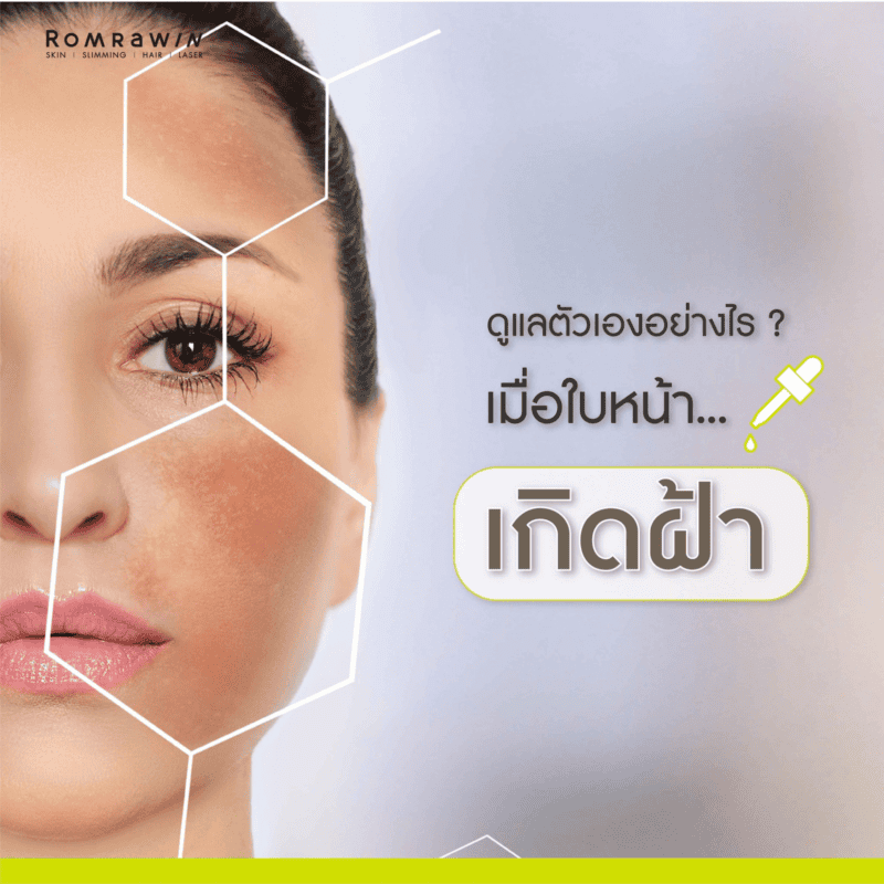 วิธีรักษาฝ้า กระ