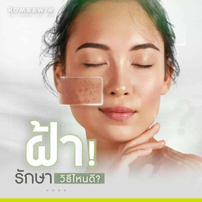 ฝ้าแดด ฝ้าเลือด