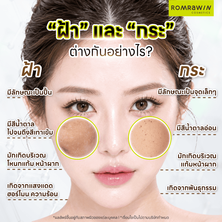 “ฝ้า กระ” ต่างกันอย่างไร